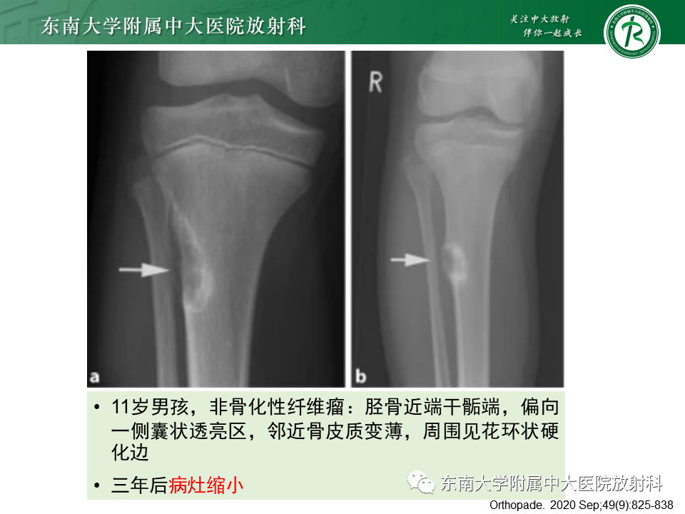 影像PPT - 【PPT】非骨化性纤维瘤-14