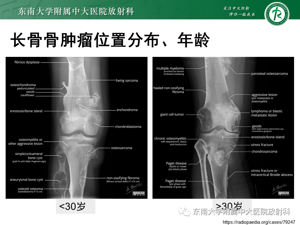 影像PPT - 【PPT】非骨化性纤维瘤-17