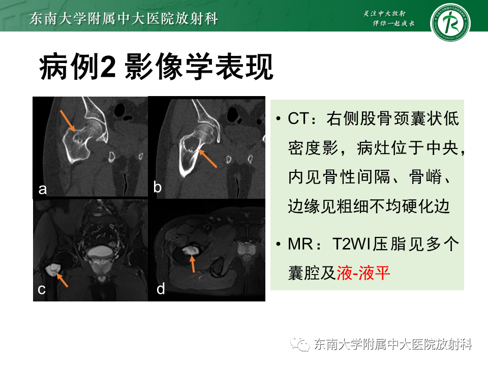影像PPT - 【PPT】非骨化性纤维瘤-20