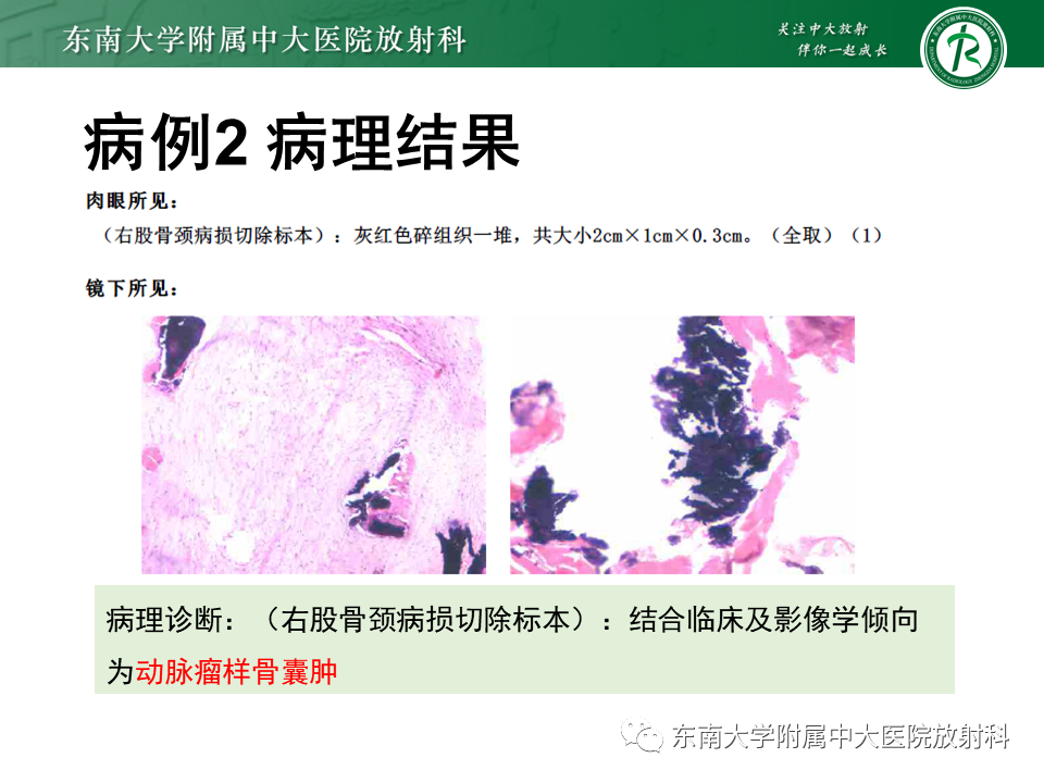 影像PPT - 【PPT】非骨化性纤维瘤-21