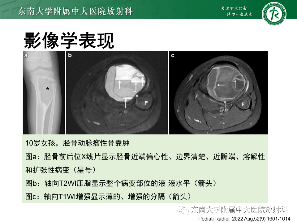 影像PPT - 【PPT】非骨化性纤维瘤-23