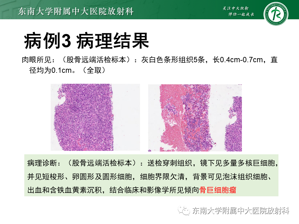影像PPT - 【PPT】非骨化性纤维瘤-26