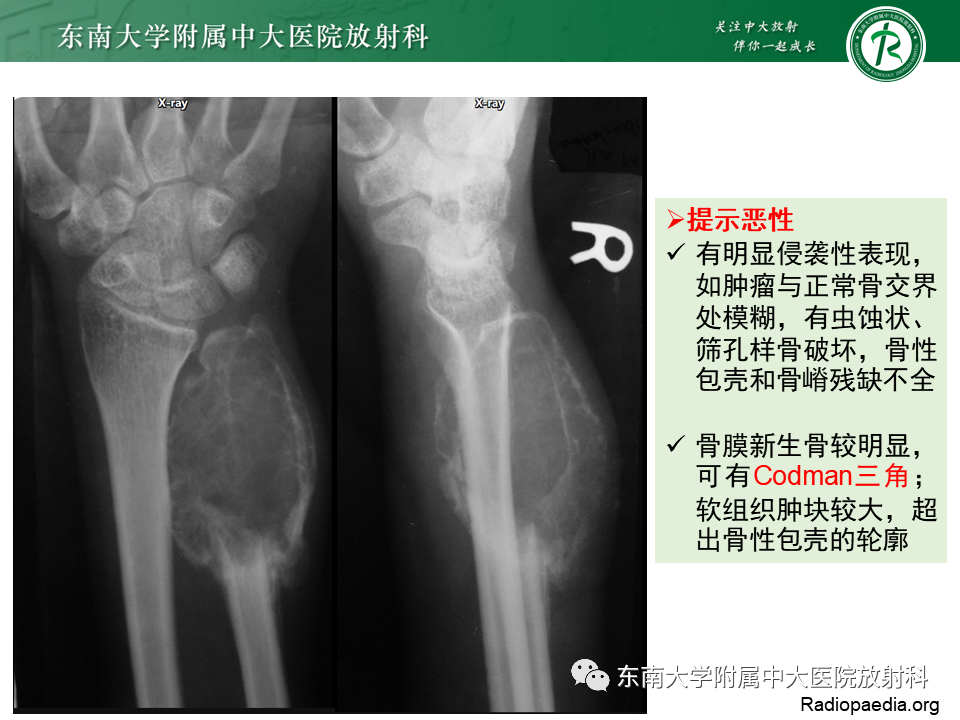 影像PPT - 【PPT】非骨化性纤维瘤-29