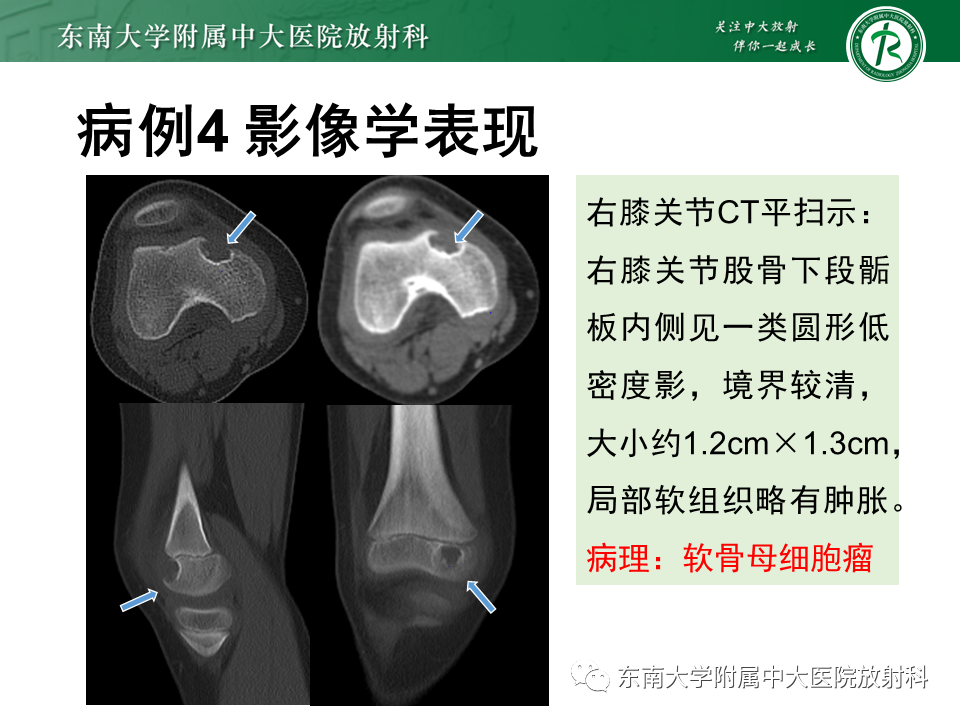 影像PPT - 【PPT】非骨化性纤维瘤-31