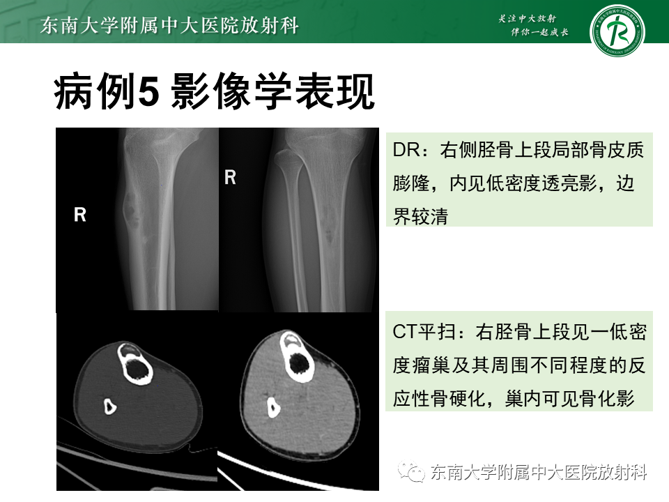 影像PPT - 【PPT】非骨化性纤维瘤-34