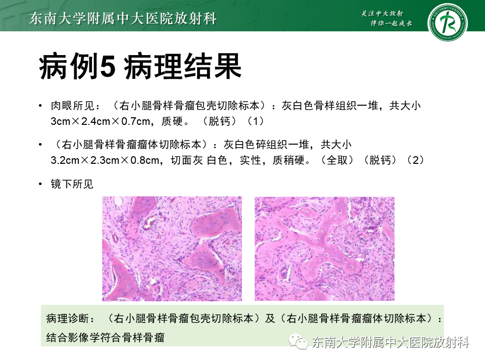 影像PPT - 【PPT】非骨化性纤维瘤-35