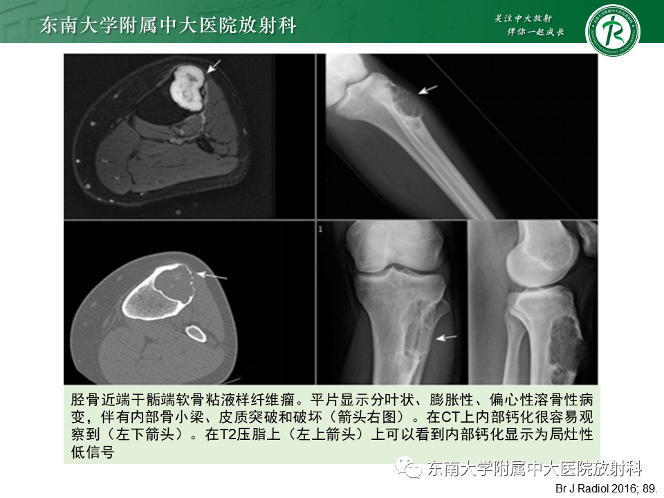 影像PPT - 【PPT】非骨化性纤维瘤-38