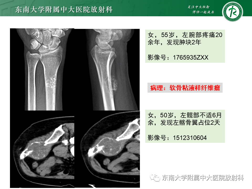 影像PPT - 【PPT】非骨化性纤维瘤-39