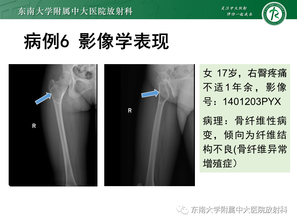 影像PPT - 【PPT】非骨化性纤维瘤-40