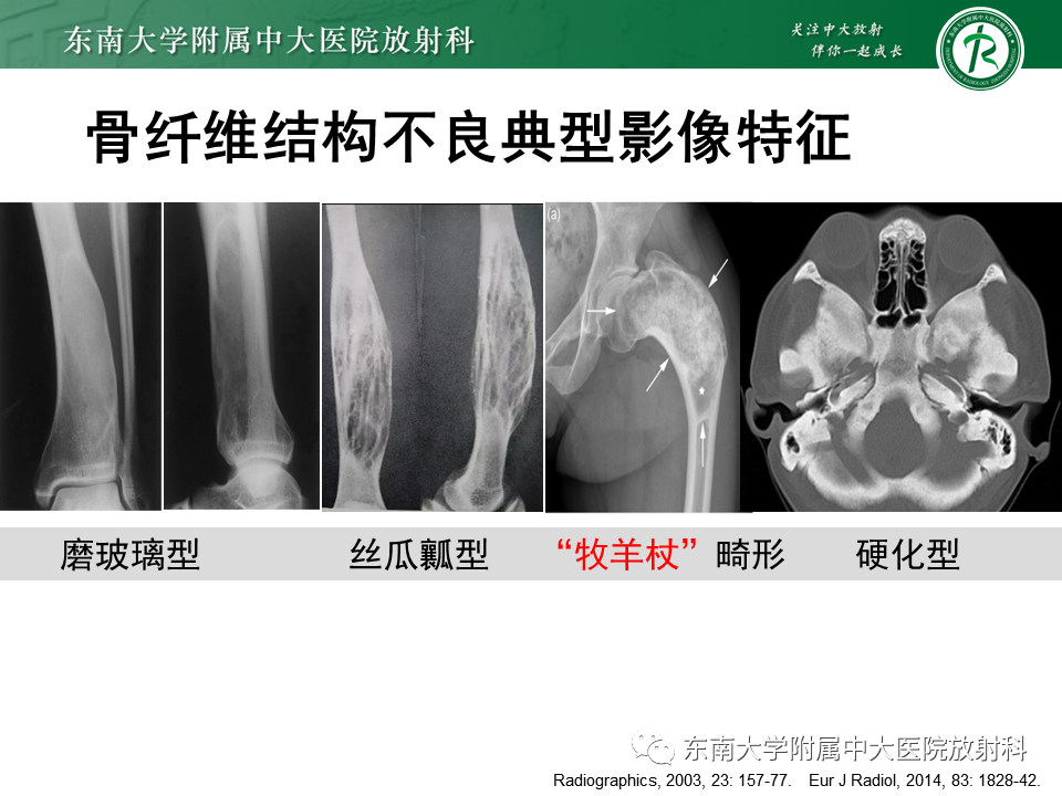 影像PPT - 【PPT】非骨化性纤维瘤-42