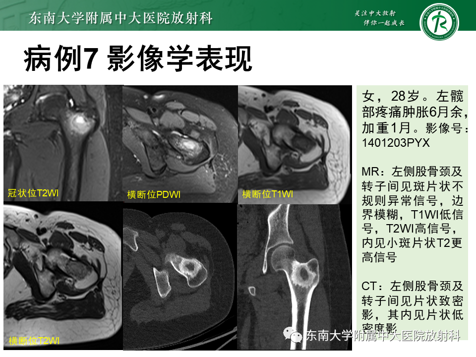 影像PPT - 【PPT】非骨化性纤维瘤-43