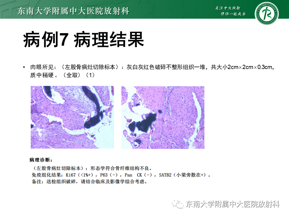 影像PPT - 【PPT】非骨化性纤维瘤-44