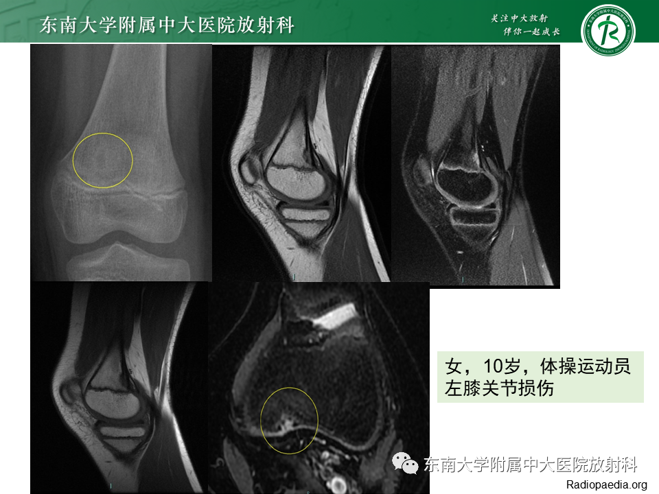 影像PPT - 【PPT】非骨化性纤维瘤-46