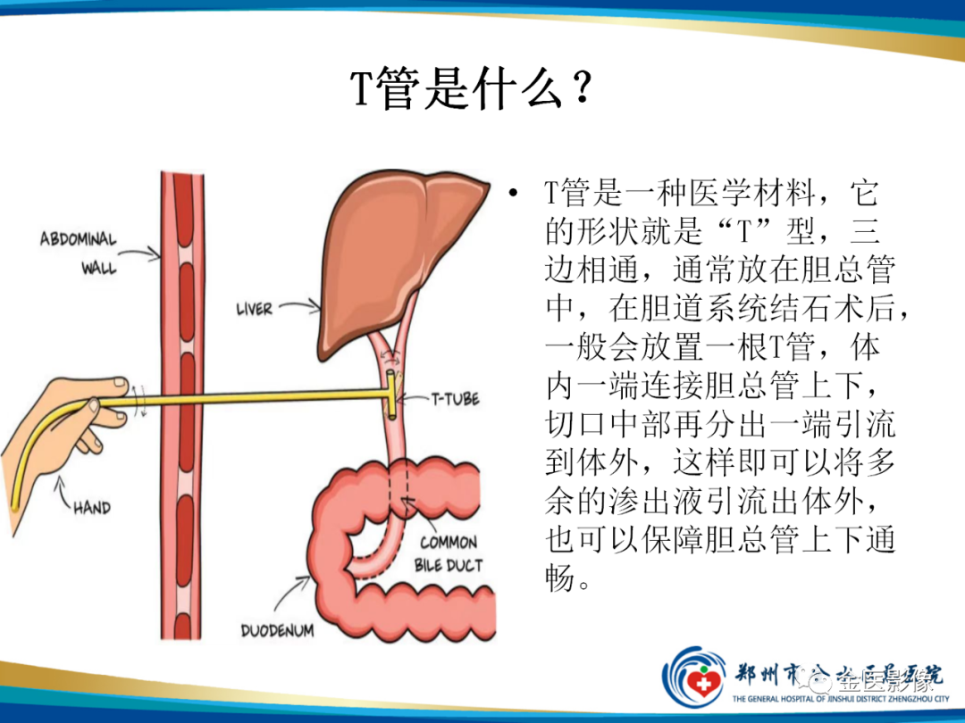 影像PPT - 【PPT】造影检查技术篇之T管造影-3