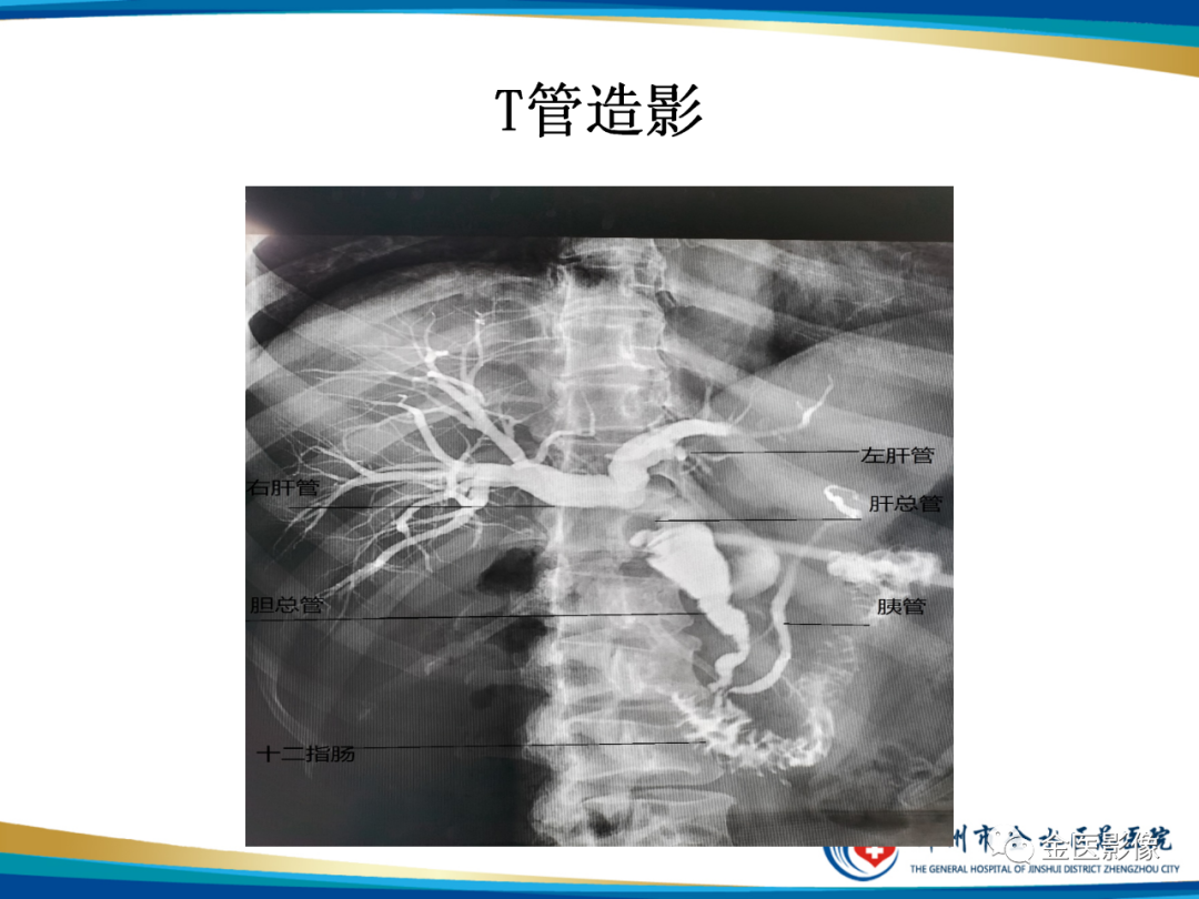 影像PPT - 【PPT】造影检查技术篇之T管造影-8