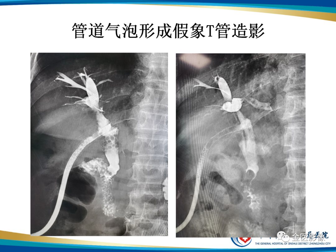 影像PPT - 【PPT】造影检查技术篇之T管造影-15