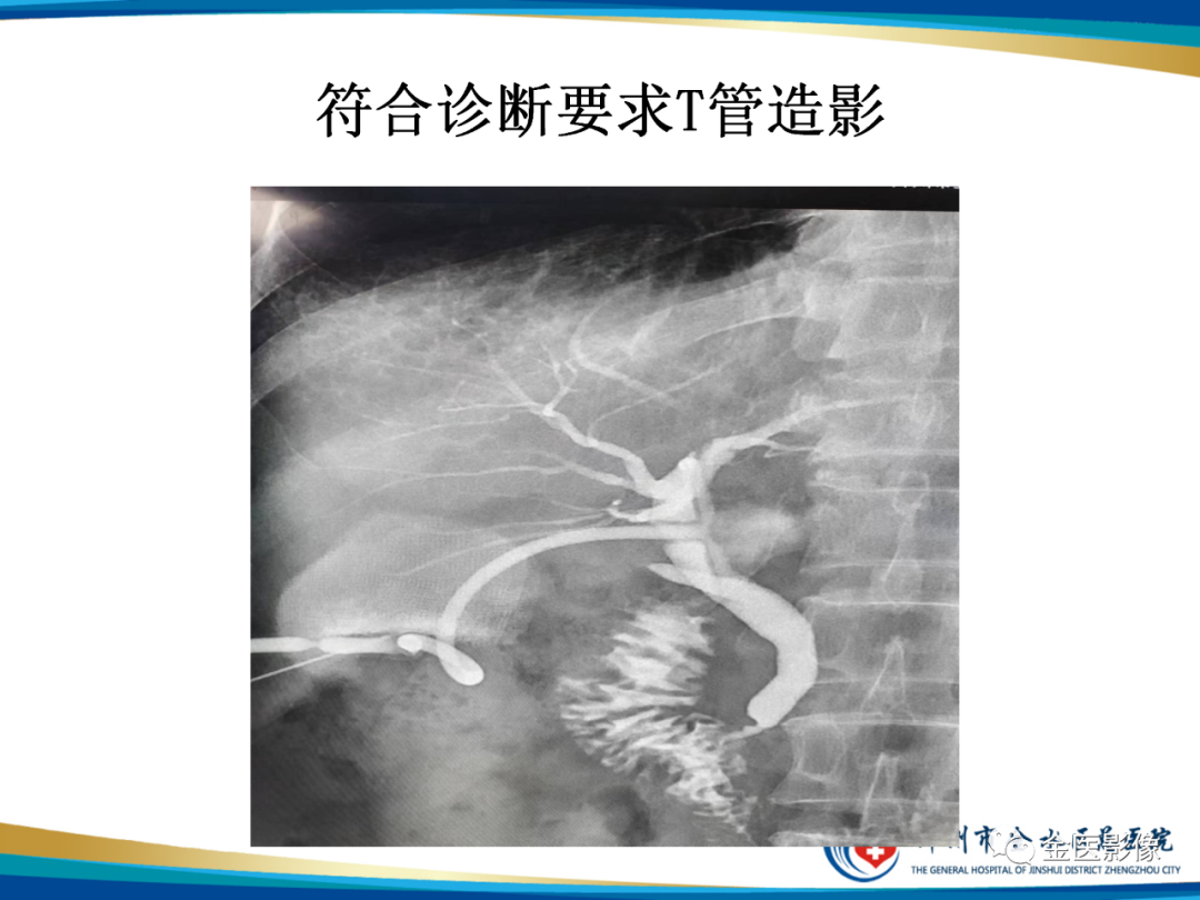 影像PPT - 【PPT】造影检查技术篇之T管造影-14