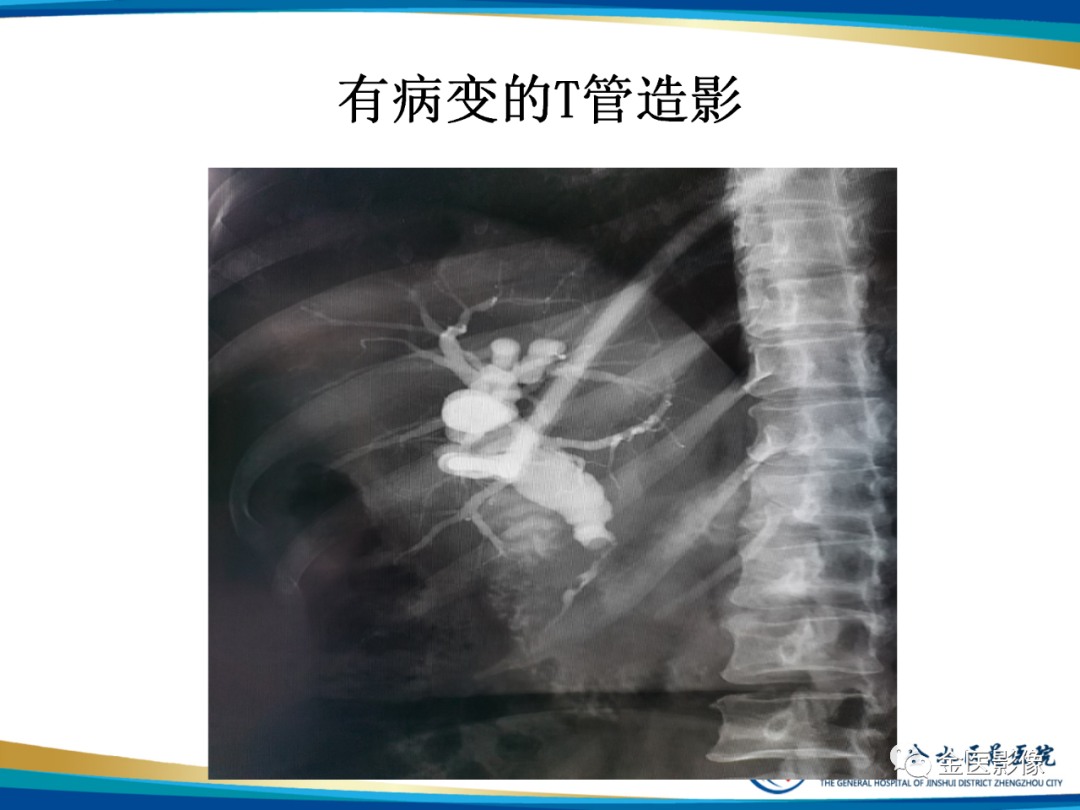 影像PPT - 【PPT】造影检查技术篇之T管造影-16