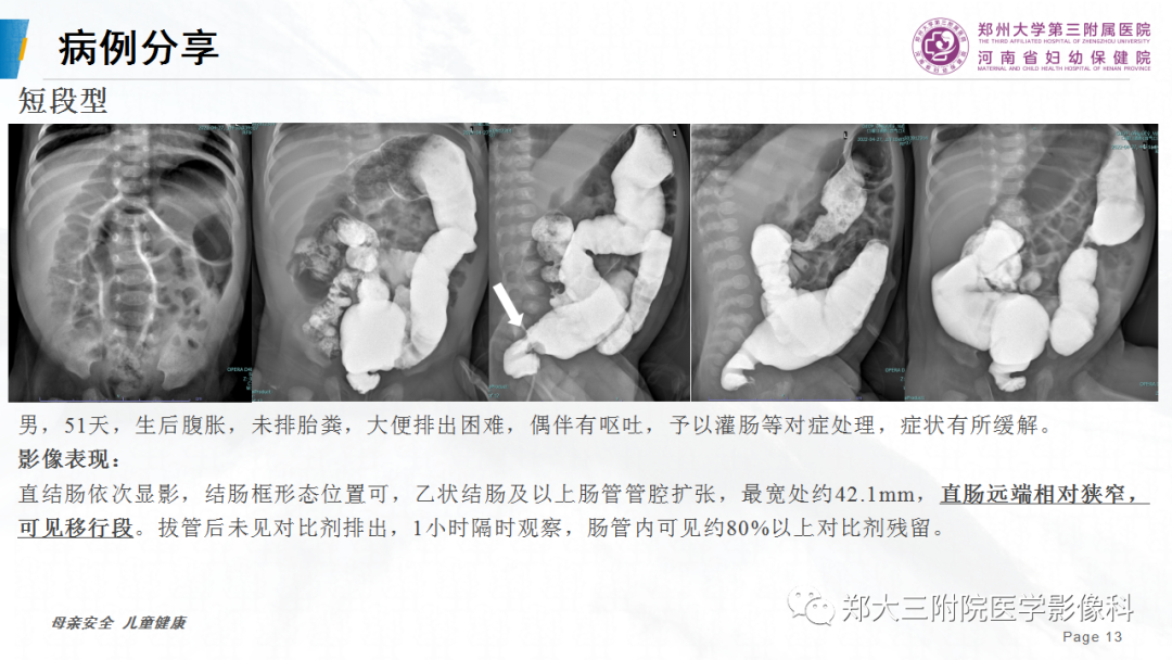影像PPT - 【PPT】先天性巨结肠-13