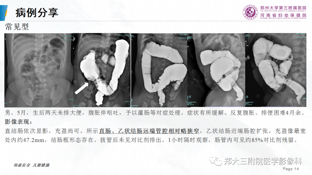 影像PPT - 【PPT】先天性巨结肠-14