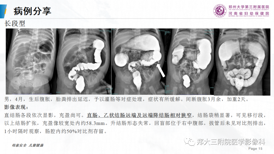 影像PPT - 【PPT】先天性巨结肠-15