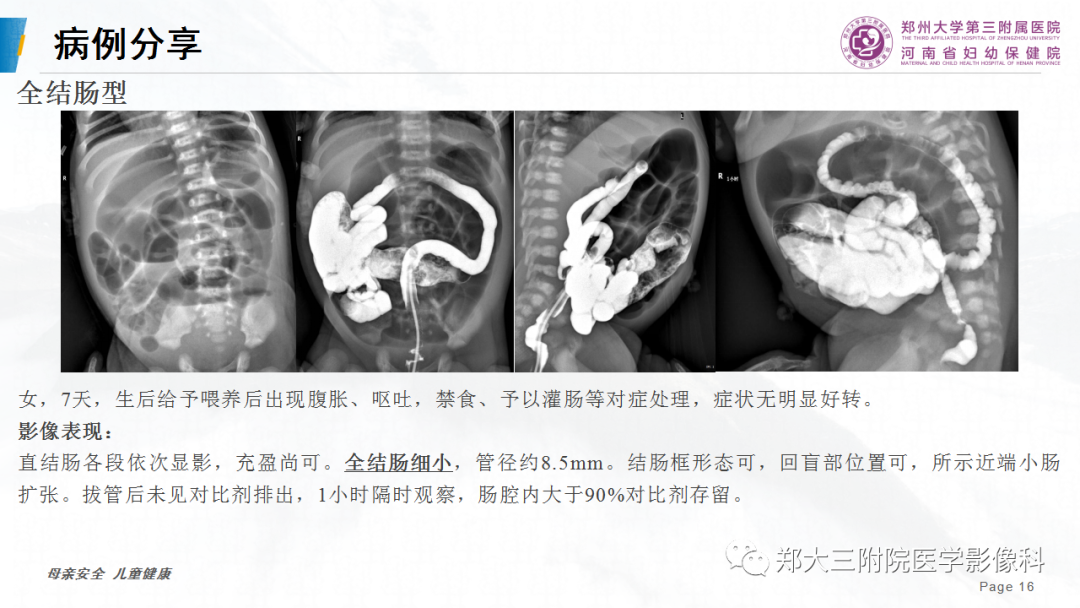影像PPT - 【PPT】先天性巨结肠-16