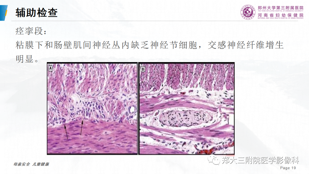 影像PPT - 【PPT】先天性巨结肠-19