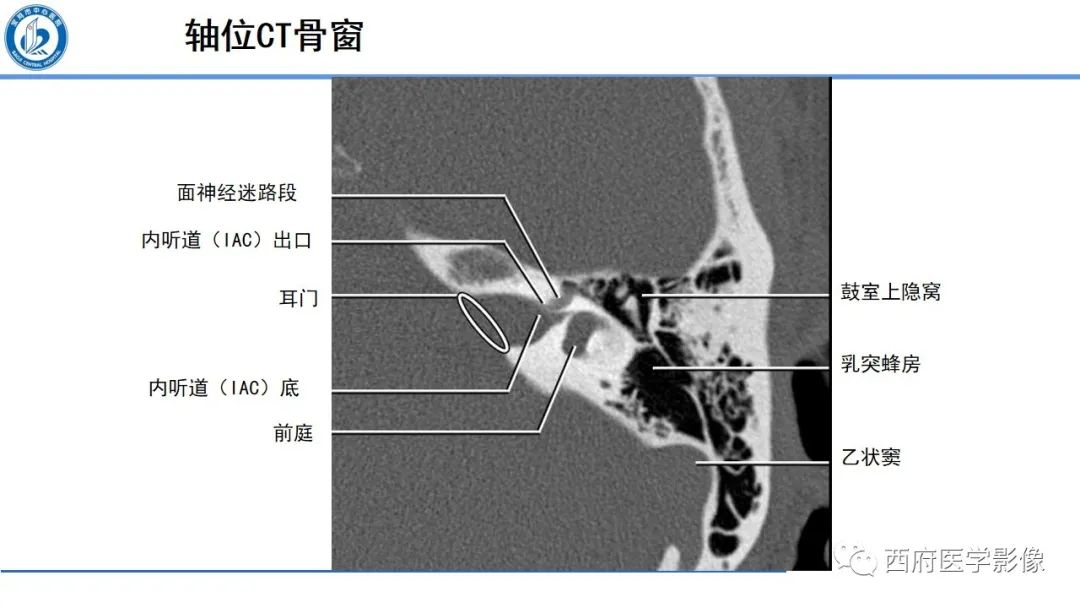 影像PPT - 【PPT】桥小脑角区占位性病变影像诊断与鉴别-4