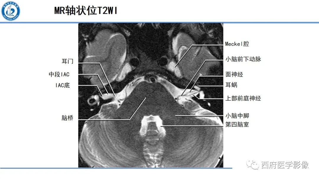 影像PPT - 【PPT】桥小脑角区占位性病变影像诊断与鉴别-5
