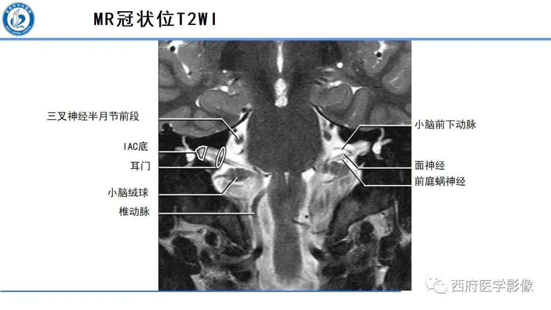影像PPT - 【PPT】桥小脑角区占位性病变影像诊断与鉴别-6