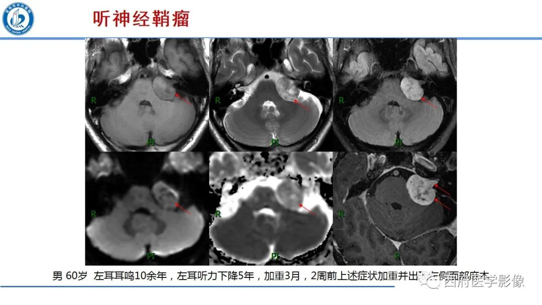 影像PPT - 【PPT】桥小脑角区占位性病变影像诊断与鉴别-12