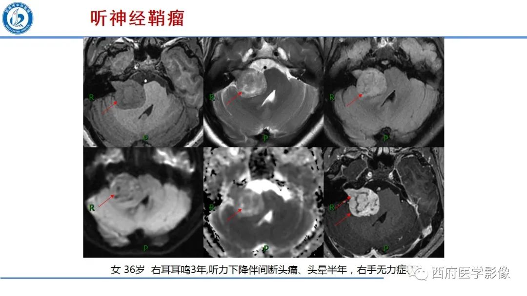 影像PPT - 【PPT】桥小脑角区占位性病变影像诊断与鉴别-11