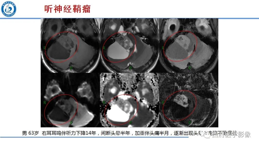 影像PPT - 【PPT】桥小脑角区占位性病变影像诊断与鉴别-10
