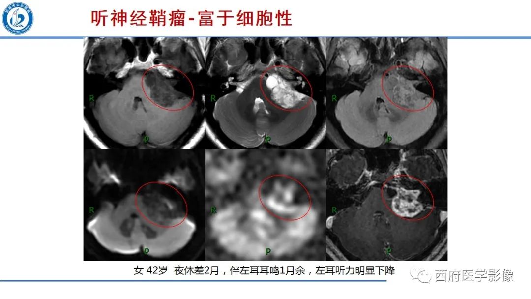 影像PPT - 【PPT】桥小脑角区占位性病变影像诊断与鉴别-14