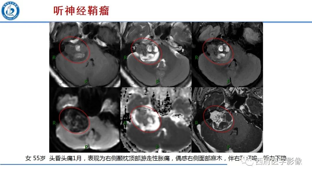 影像PPT - 【PPT】桥小脑角区占位性病变影像诊断与鉴别-13