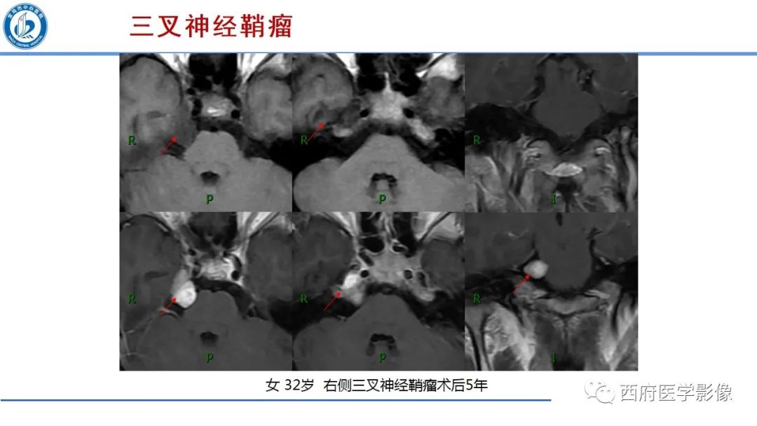 影像PPT - 【PPT】桥小脑角区占位性病变影像诊断与鉴别-19