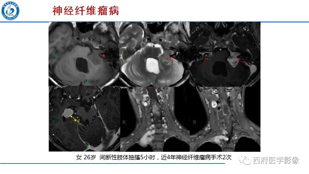 影像PPT - 【PPT】桥小脑角区占位性病变影像诊断与鉴别-17