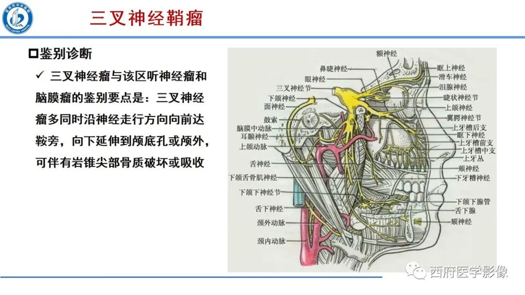影像PPT - 【PPT】桥小脑角区占位性病变影像诊断与鉴别-20