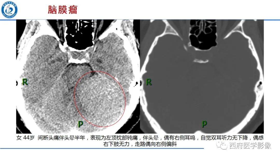 影像PPT - 【PPT】桥小脑角区占位性病变影像诊断与鉴别-22