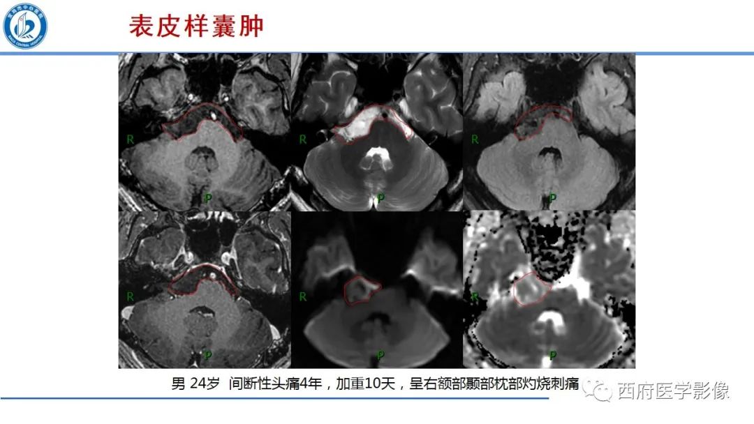 影像PPT - 【PPT】桥小脑角区占位性病变影像诊断与鉴别-27
