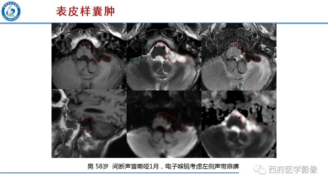 影像PPT - 【PPT】桥小脑角区占位性病变影像诊断与鉴别-28