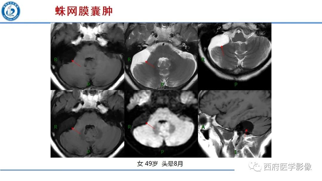 影像PPT - 【PPT】桥小脑角区占位性病变影像诊断与鉴别-33