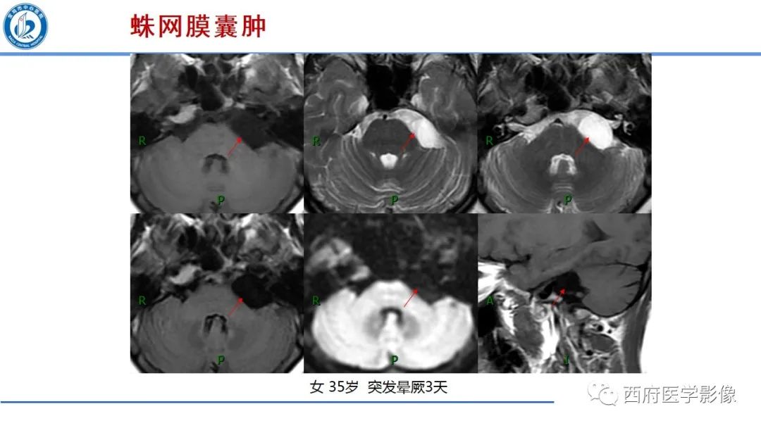影像PPT - 【PPT】桥小脑角区占位性病变影像诊断与鉴别-34