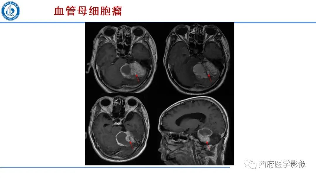影像PPT - 【PPT】桥小脑角区占位性病变影像诊断与鉴别-37