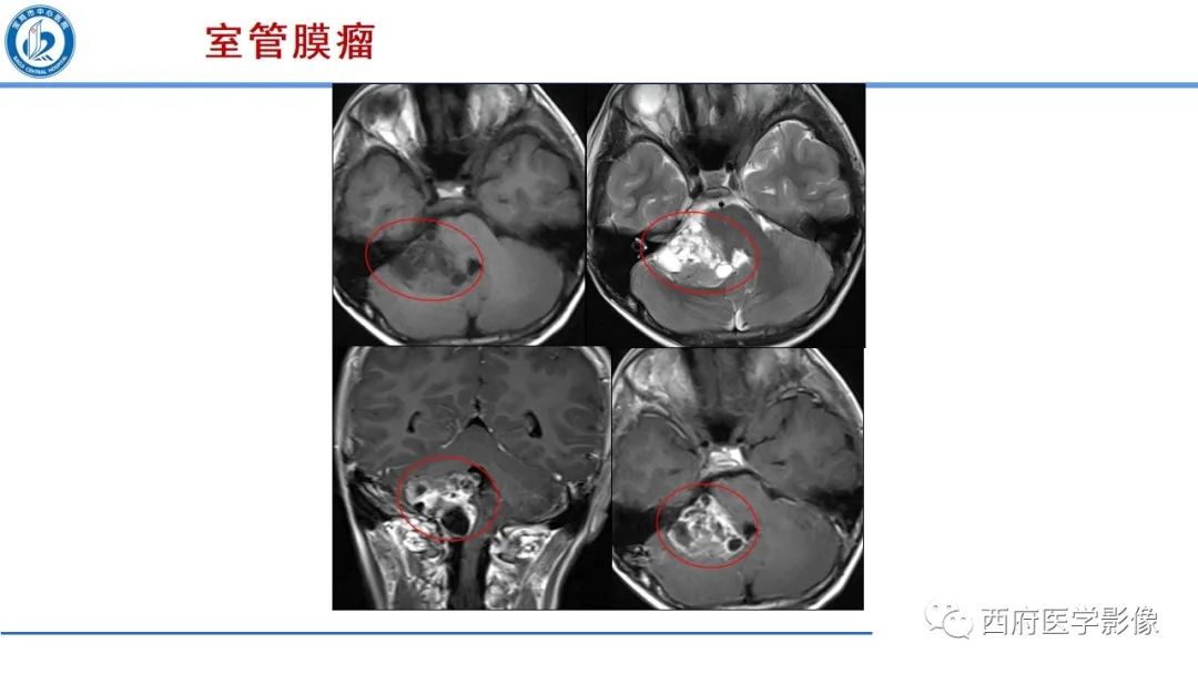 影像PPT - 【PPT】桥小脑角区占位性病变影像诊断与鉴别-39