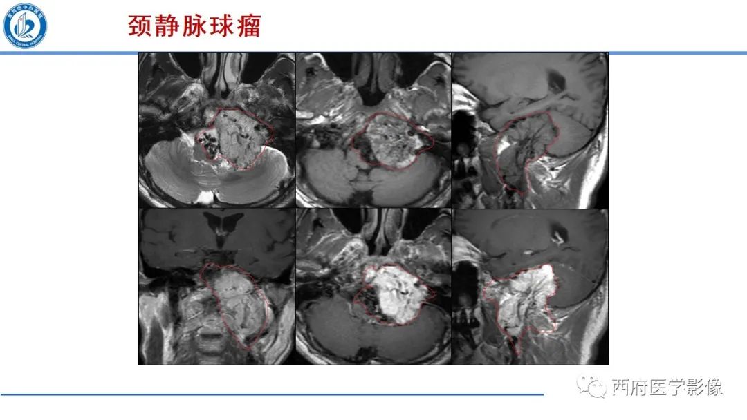 影像PPT - 【PPT】桥小脑角区占位性病变影像诊断与鉴别-41