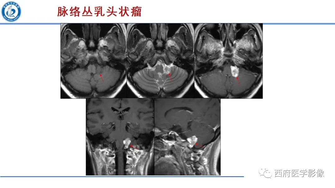 影像PPT - 【PPT】桥小脑角区占位性病变影像诊断与鉴别-43