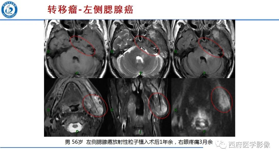 影像PPT - 【PPT】桥小脑角区占位性病变影像诊断与鉴别-45