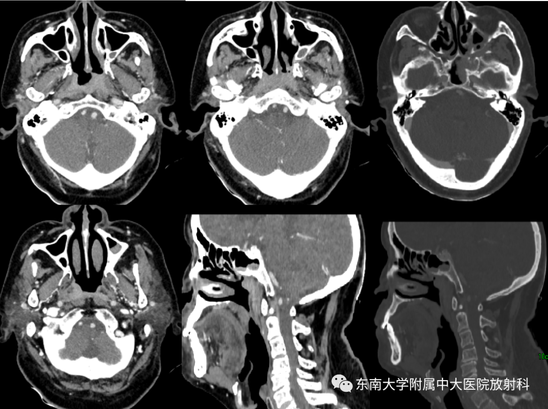 影像PPT - 【PPT】鼻咽癌影像及分期-2