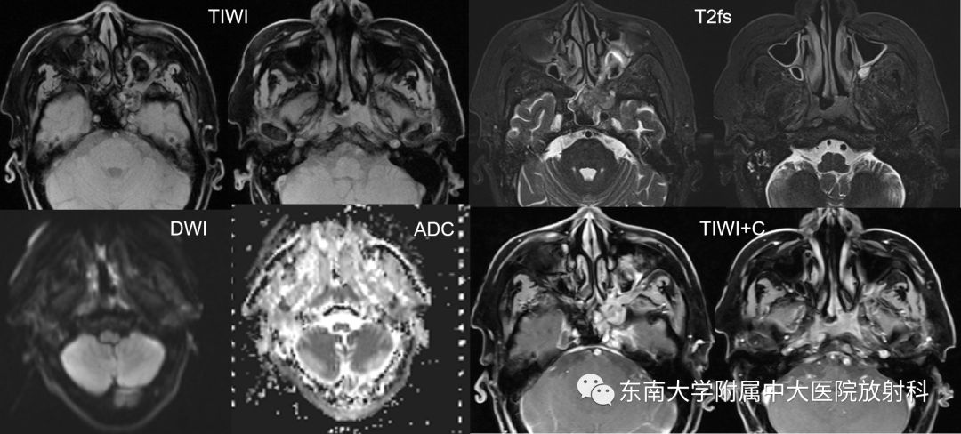 影像PPT - 【PPT】鼻咽癌影像及分期-3